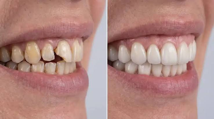 Celebrity Dental Implants